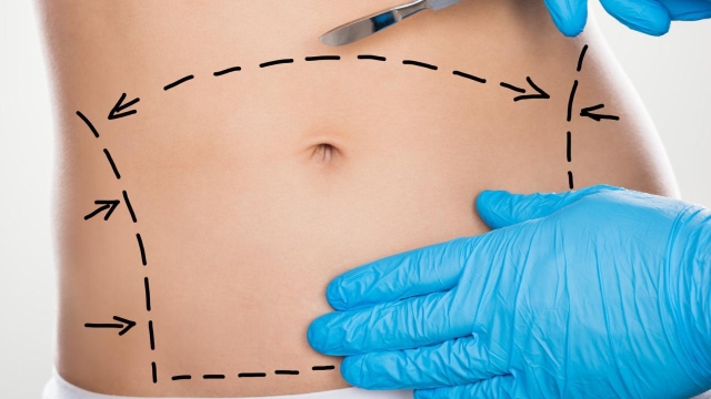 Flatten Your Tummy: Unveiling the Secrets of Abdominoplasty