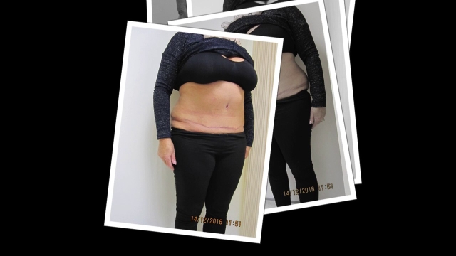 Tummy Tucks: Transform Your Abdomen with Abdominoplasty