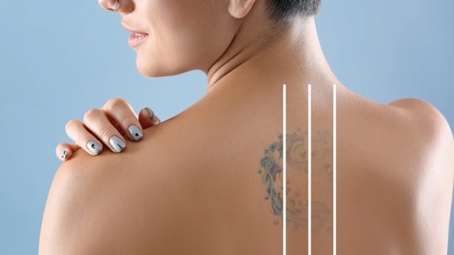 Bad Tattoos Are Ever-Increasing – Safe And Sound ? Tattoo Removal