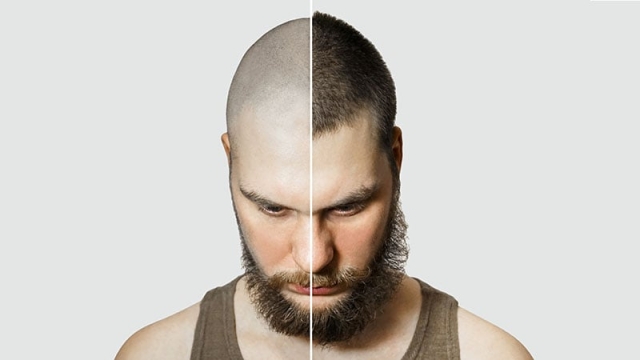 Bald No More: The Ultimate Guide to Hair Implants