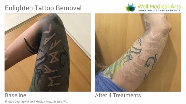 Tattoo Removal Options – Laser Tat Removal Or Even A Tattoo Removal Cream