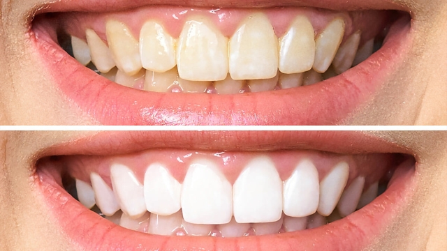 Brighten Your Smile: The Top Teeth Whitening Products for Dazzling Results!