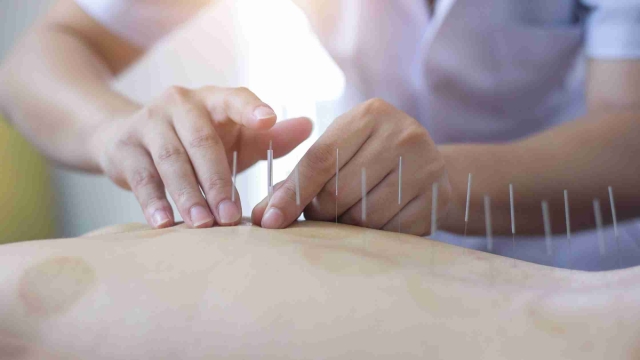 The Art of Healing: Exploring the World of Acupuncture